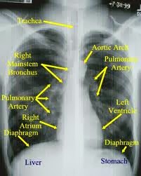 Asthma Diagnosis with Chest X-Ray