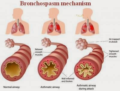 Asthma Pathophysioloy and Bronchospasm Mechanism