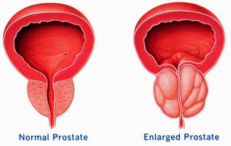 Prostate Infection