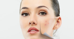 Acne Treatment with simple home remedies for women