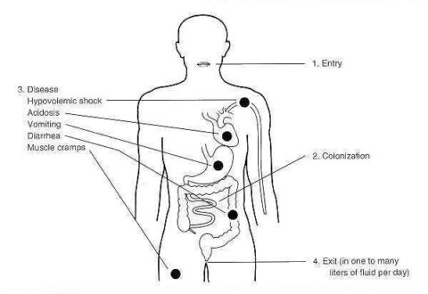 Irritable bowel Syndrome (IBS) Symptoms, Causes, Treatment and Diet