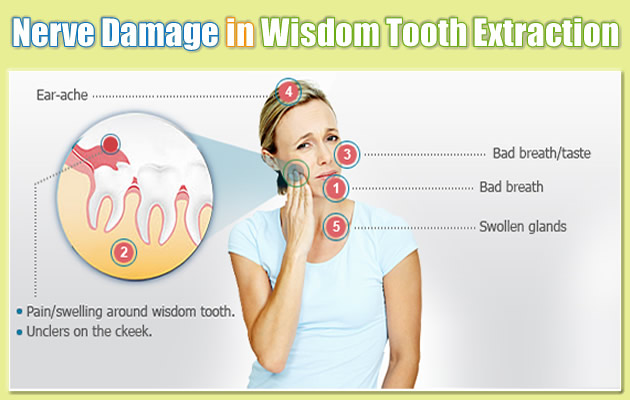 Paresthesias: Nerve damage after Wisdom tooth extraction