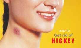 Get Rid of Hickeys on Neck, Lips, Chest Fast Overnight