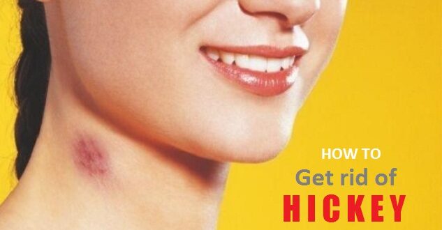 To get rid of a lip hickey