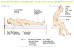 paroxysmal nocturnal dyspnea