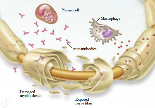 chronic-inflammatory-demyelinating-polyneuropathy-symptoms-causes