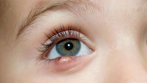 How to Get Rid of Stye on Upper/Bottom Eyelid