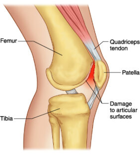 Patellofemoral Pain Syndrome Symptoms and Treatment with Surgery, Physical therapy