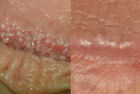 Pearly penile papules laser treatment