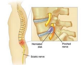 Cervical Radiculopathy Treatment: Surgery, Physical therapy