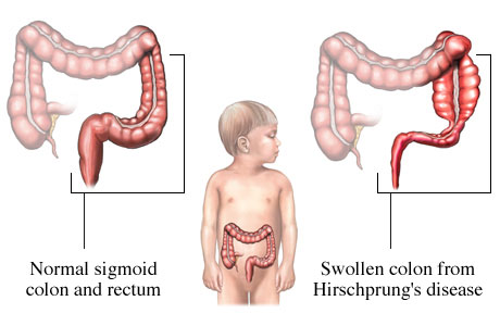 Hirschsprung's Disease Symptoms, Diagnosis, Causes, Treatment