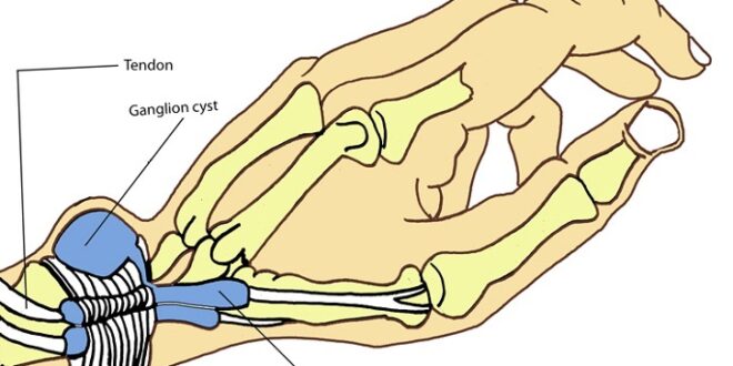 Ganglion Cyst Symptoms, Removal, Treatment, Surgery