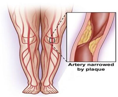 Intermittent Claudication Pain Treatment