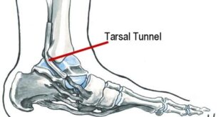 Tarsal Tunnel Syndrome Symptoms, MRI Test, Surgery