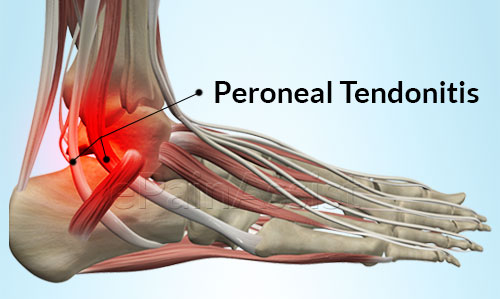 Peroneal Tendonitis Symptoms, Causes, Treatment at Home