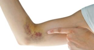 How to Give Yourself a Bruise Fast, Easily, Painless