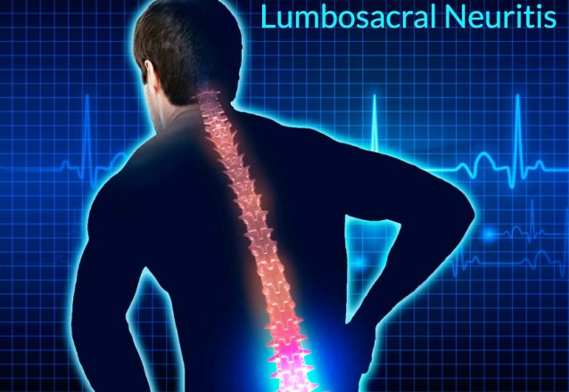 7244 Lumbosacral Neuritis Definition Symptoms Types Causes Treatment
