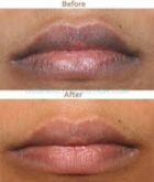 Lips Discoloration, Symptoms, Causes, Treatment