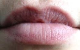 Lips Discoloration, Symptoms, Causes, Treatment