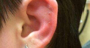 Infected Cartilage Piercing Symptoms, Treatment