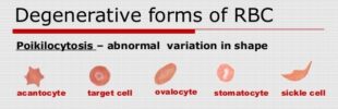 Poikilocytosis Definition, Causes, Symptoms, Treatment