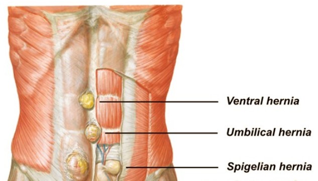 Грыжа прямой мышцы. Грыжа спигелиевой линии живота анатомия. Грыжа спигелиевой линии анатомия. Грыжи спигелевой линии. Грыжа полулунной линии живота.