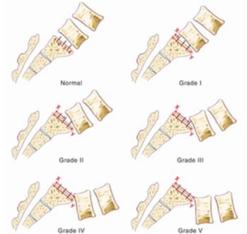 Anterolisthesis Grade 1-2, Treatment, Symptoms, Causes