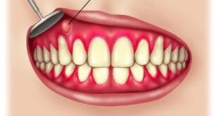 Gum Boils (Abscess) Pictures, Symptoms, Causes, Treatment