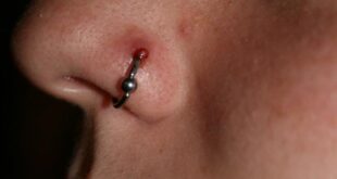 Nose Piercing Bump, Infection, Keloid, Lump on Ring Causes & Treatment