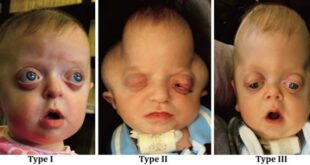 Pfeiffer Syndrome Pictures, Causes, Symptoms, Treatment
