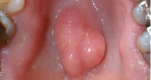 Torus Palatinus (Bump on Roof of Mouth), Causes, Diagnosis, Removal treatment