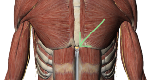 Xiphoid Process: Sternum Lump Pain Treatment