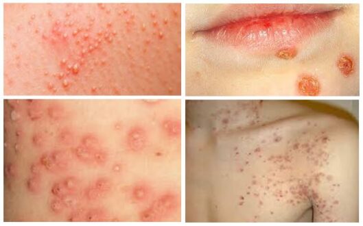 Invatago What is Infantigo (Impetigo) - Images, Treatment, Causes, Symptoms