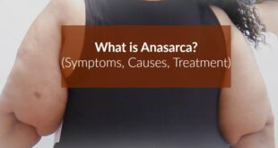 Anasarca - Definition, Pictures, Causes, Treatment