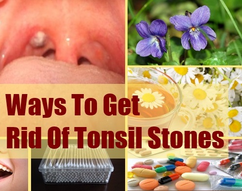 Holes/Crypts in Tonsils and Strep Throat - Pictures and Treatment