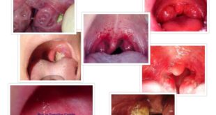 Holes/Crypts in Tonsils and Strep Throat – Pictures