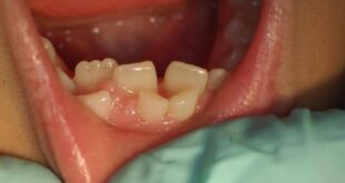 Hyperdontia (Extra Teeth) Causes, Treatment and Removal