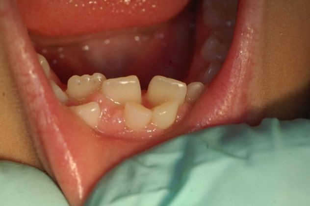 Hyperdontia (Extra Teeth) Causes, Treatment and Removal