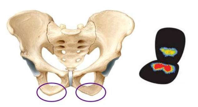 Ischial Tuberosity Syndrome Pain, Pictures, Treatment