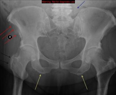 Ischial Tuberosity Syndrome Pain Pictures Treatment