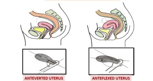 Anteverted Uterus Symptoms, Pictures, Treatment and Pregnancy