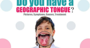 Geographic Tongue Pictures, Symptoms, Treatment, Causes