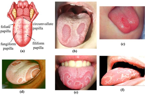 Geographic Tongue Pictures