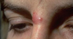 Cyst on Nose - Causes, Treatment, Removal, Pictures