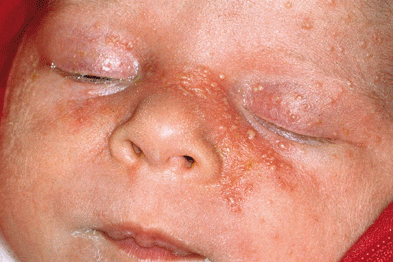 Sebaceous Hyperplasia Photos