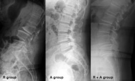 Retrolisthesis grade 1 picture