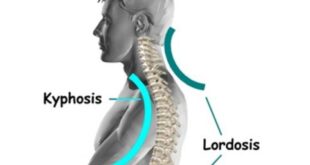 Cervical Lordosis - Loss, Reversal, Treatment