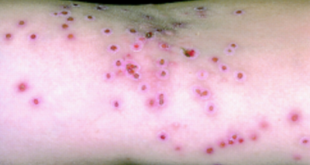 Eczema Herpeticum - Symptoms and Treatment