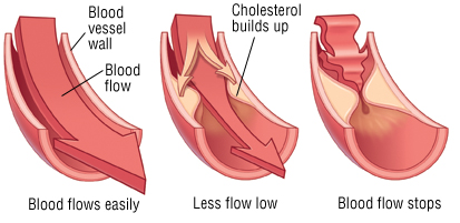 Pure Hypercholesterolemia Definition, Symptoms