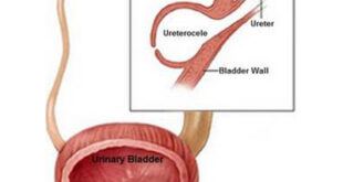 Ureterocele Pictures, Symptoms, Causes, Diagnosis, Treatment, Ultrasound